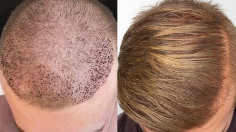 Возрождение мужественности: изучаем возможности пересадки волос для мужчин в Москве