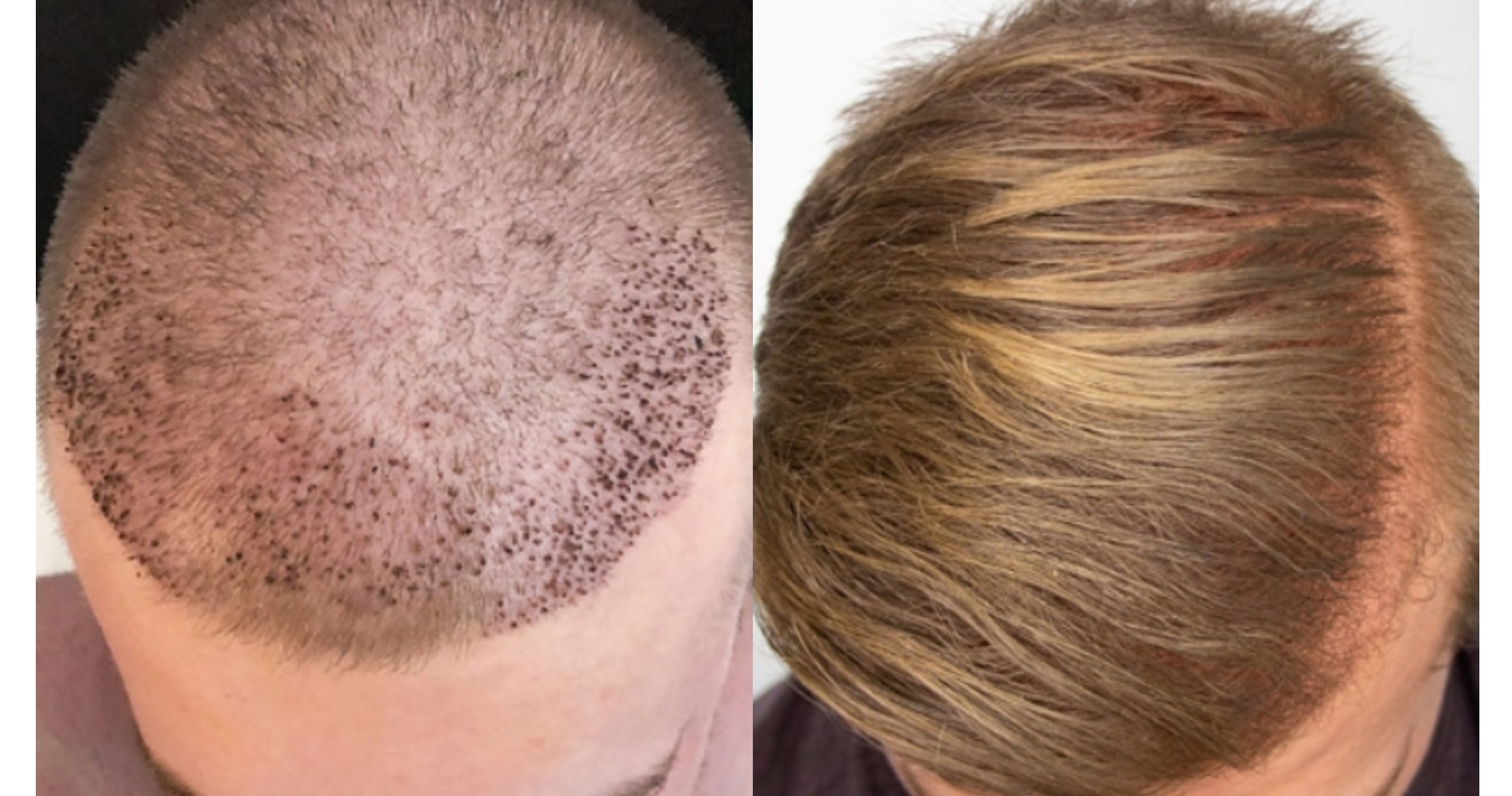 Возрождение мужественности: изучаем возможности пересадки волос для мужчин в Москве